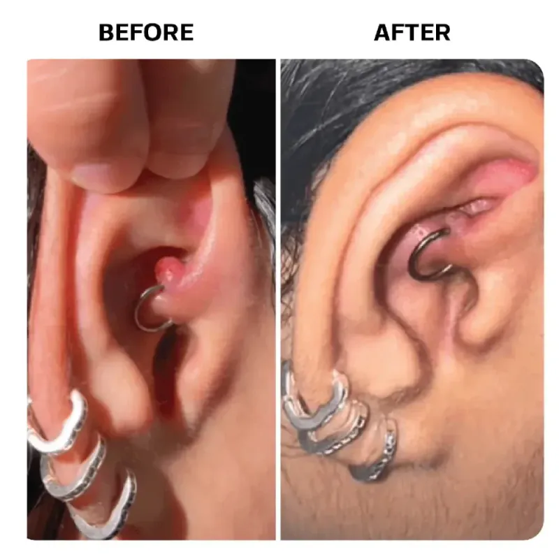 Keloid Repair Duo