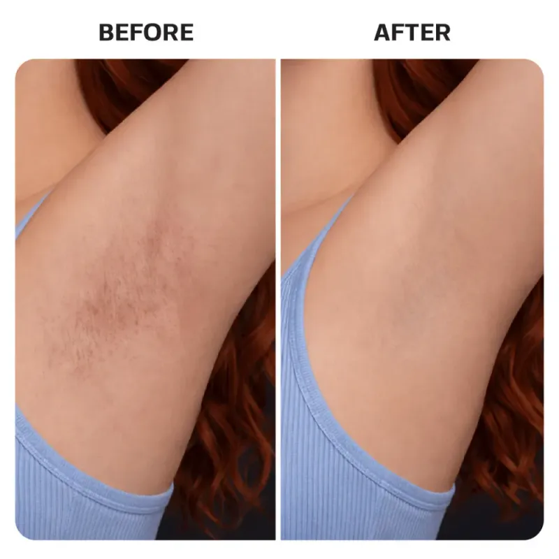 Ingrown Hair Treatment Pads